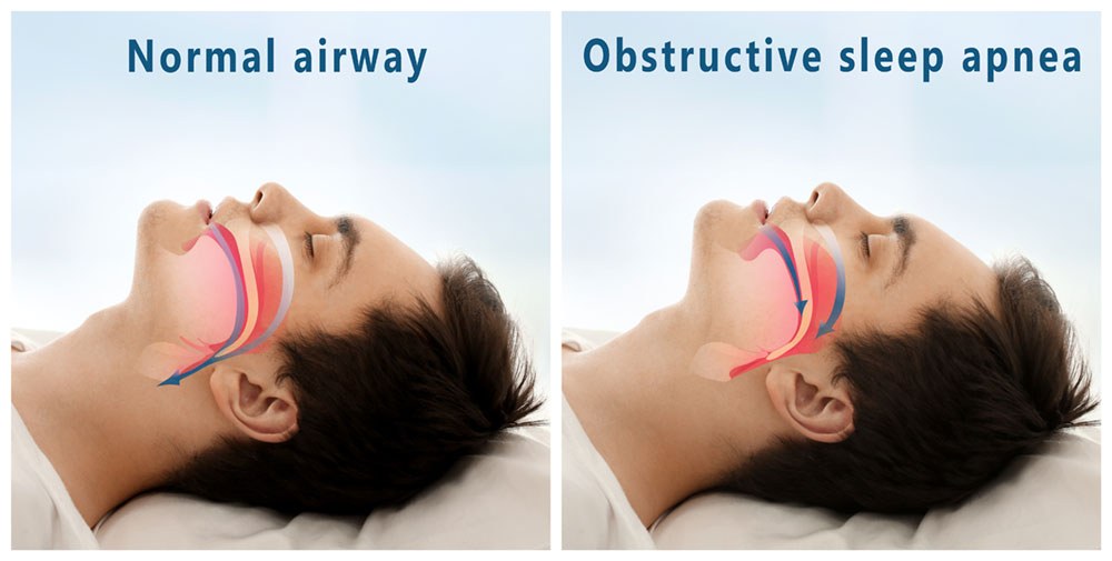 Side by side images of same man sleeping, one depicting normal airway and the other showing obstructive sleep apnea